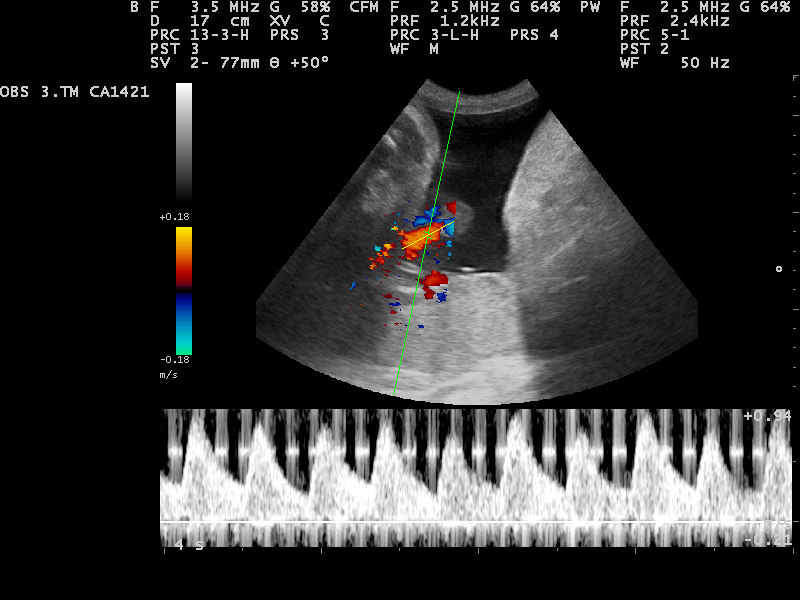 Single Umbilical Artery (SUA): Getting the Call